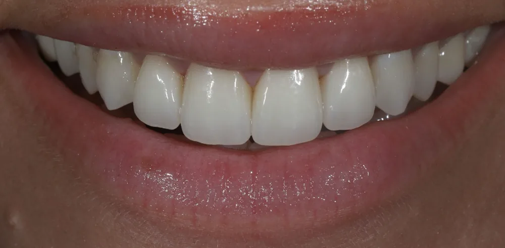 After: smile following cosmetic treatment by The Dental Spa in Philadelphia.