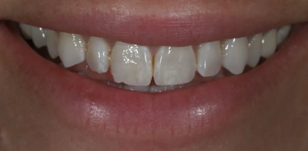 Before: smile prior to cosmetic treatment at The Dental Spa in Philadelphia.