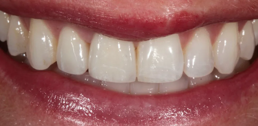 After: smile following cosmetic treatment by The Dental Spa in Philadelphia.