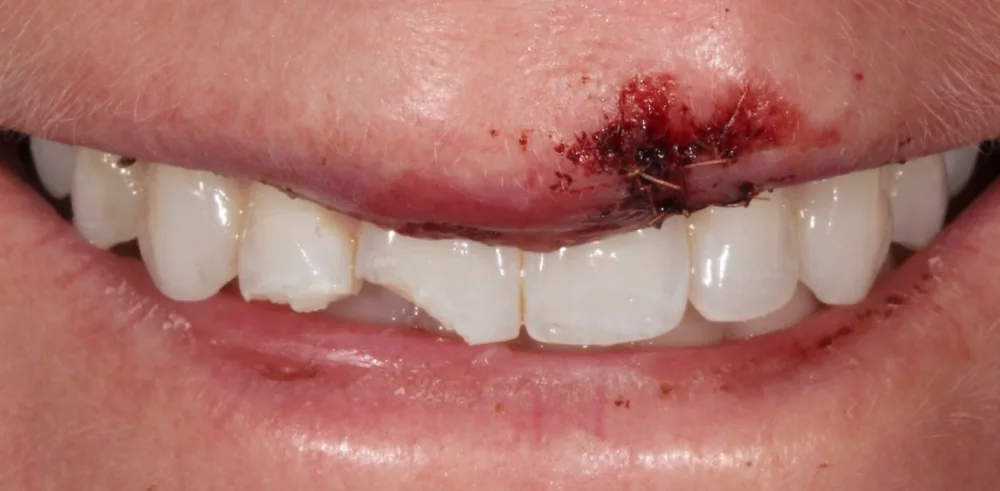 Before: smile prior to cosmetic treatment at The Dental Spa in Philadelphia.