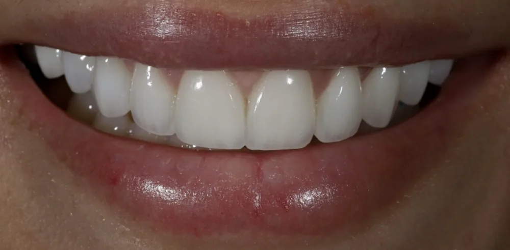 After: smile following cosmetic treatment by The Dental Spa in Philadelphia.