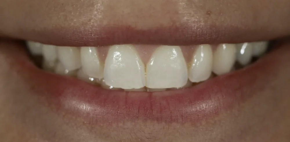 Before: smile prior to cosmetic treatment at The Dental Spa in Philadelphia.