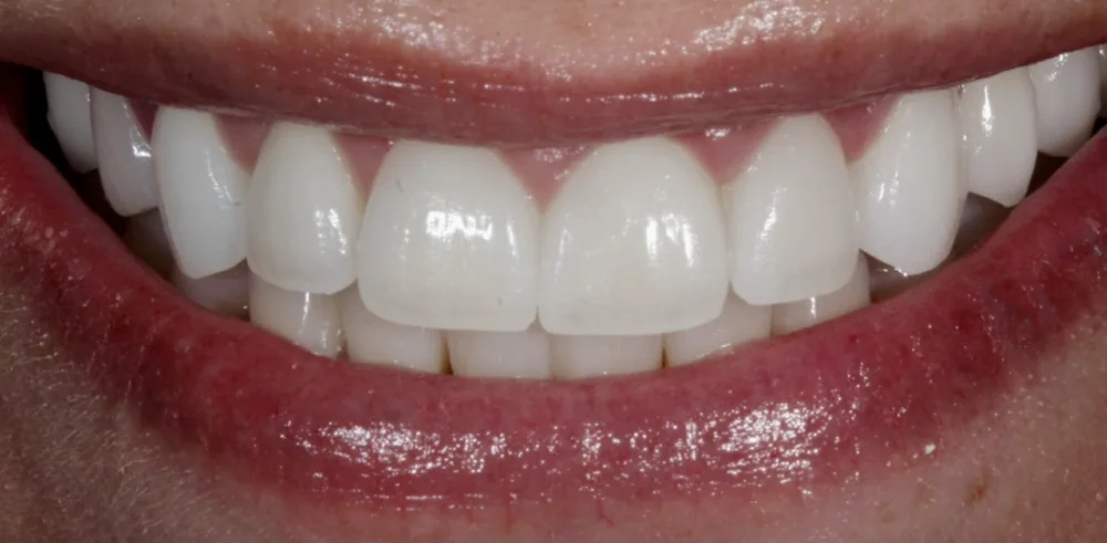 After: smile following cosmetic treatment by The Dental Spa in Philadelphia.