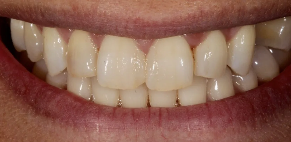 Before: smile prior to cosmetic treatment at The Dental Spa in Philadelphia.